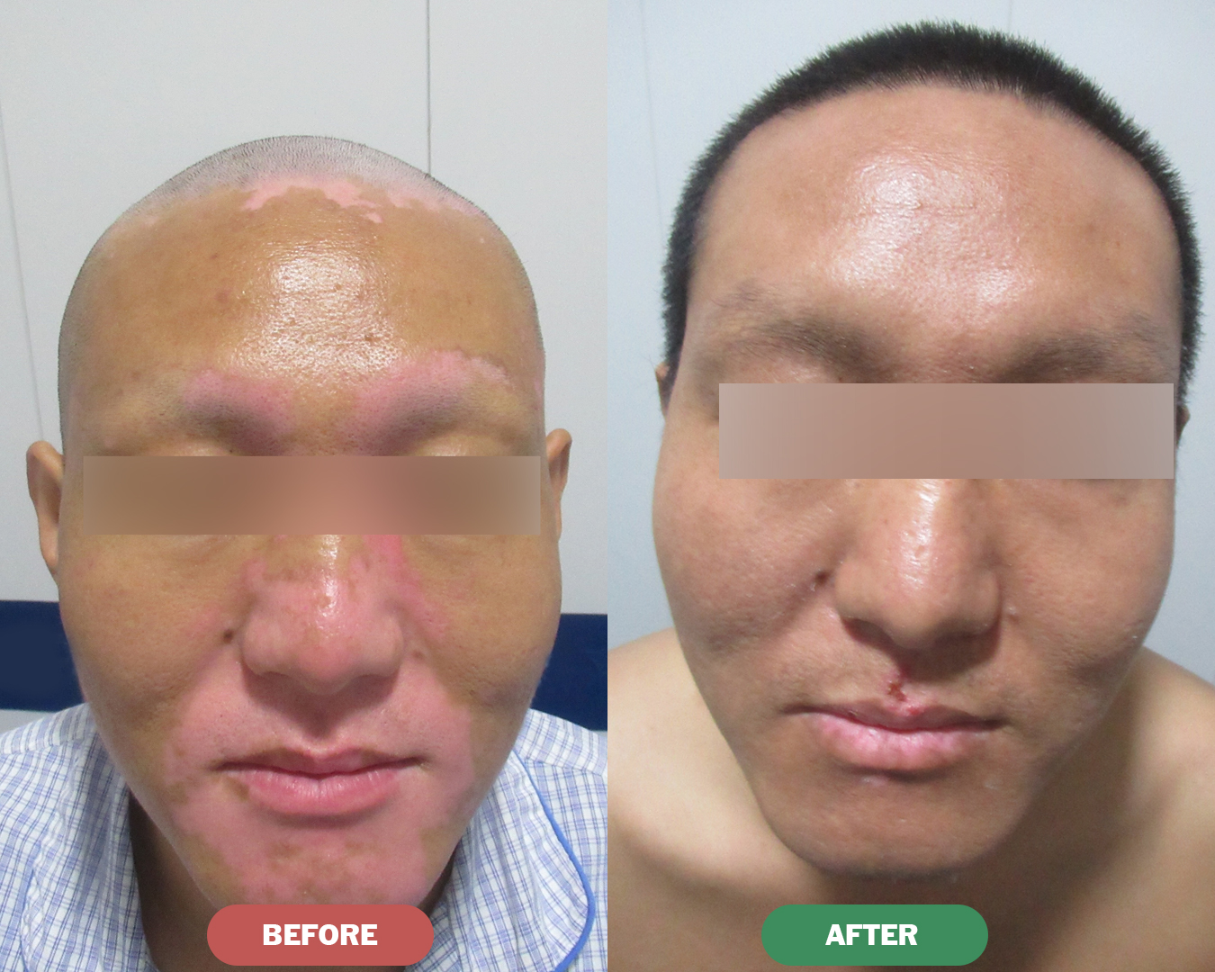Before & After - Facial Vitiligo Treatment
