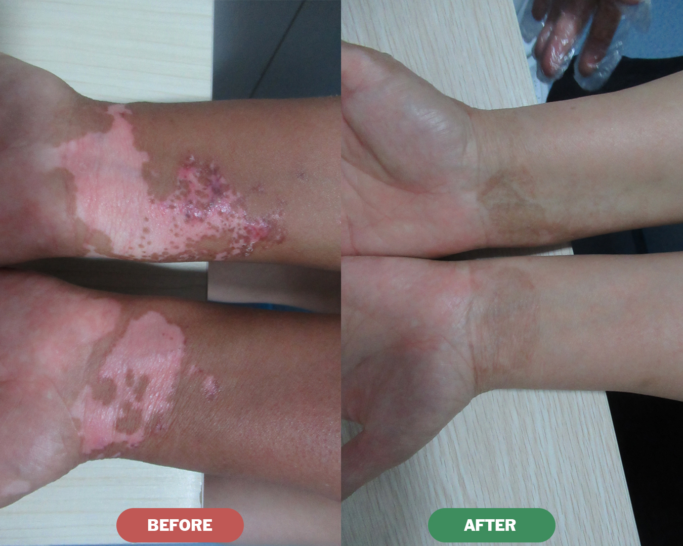 Before & After - Hand Vitiligo Treatment