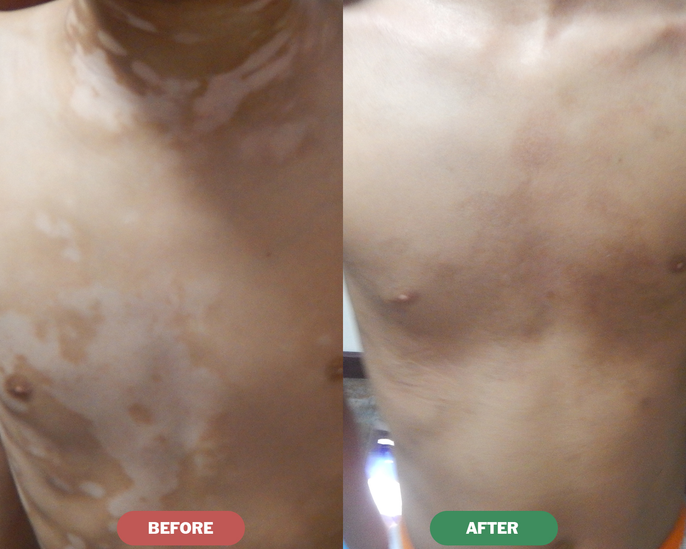 Before & After - Neck Vitiligo Treatment