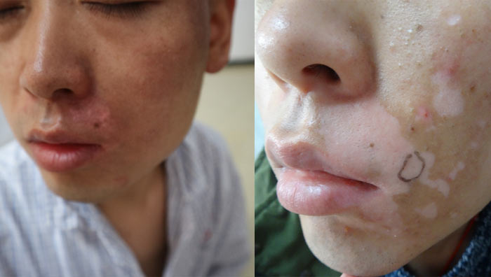 vitiligo on face