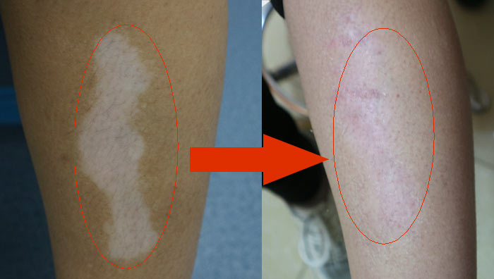 vitiligo on legs
