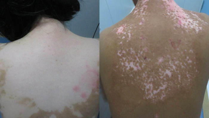 vitiligo on back 
