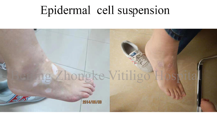 vitiligo on foot 